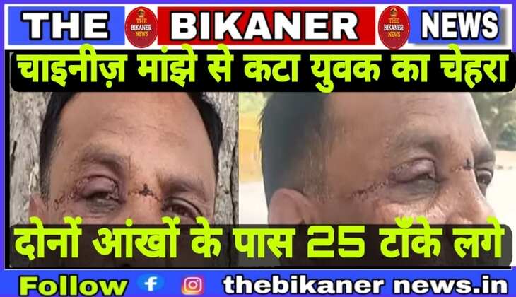 Bikaner:-चाइनीज़ मांझे से युवक के चेहरे में लगे 25 टांके,इन जानलेवा हादसों में लालची दुकानदारों के साथ ये पतंगबाज भी है दोषी:-देखे खास रिपोर्ट